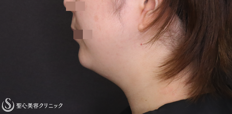 【30代女性・顎周りをスッキリ】ベイザー脂肪吸引（1ヶ月後） Before 