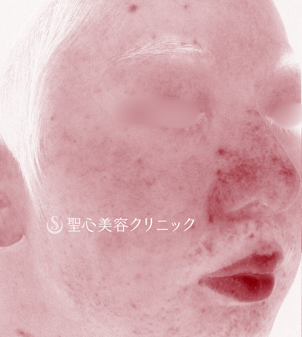 【20代男性・鼻の赤みに対する治療】585 - Quanta System Ｑ1（2回施術後1ヶ月）​　　 Before 