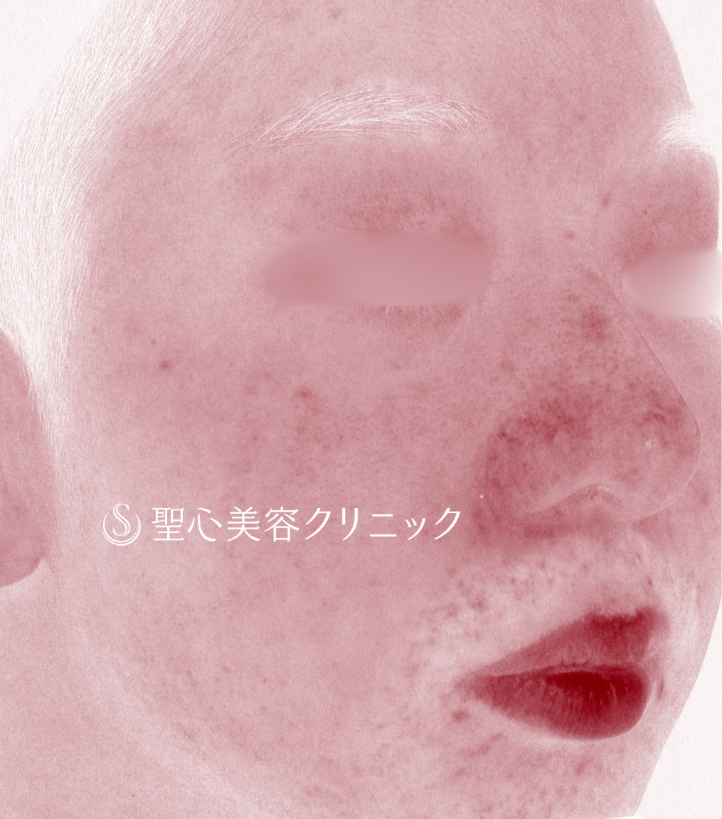 【20代男性・鼻の赤みに対する治療】585 - Quanta System Ｑ1（2回施術後1ヶ月）​　　 After 