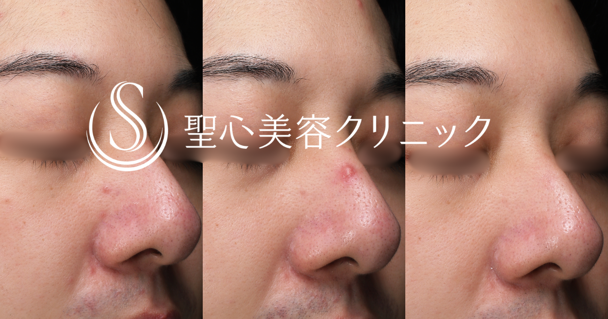 【20代男性・鼻の赤みに対する治療】585 - Quanta System Ｑ1（2回施術後1ヶ月）​　　 After 