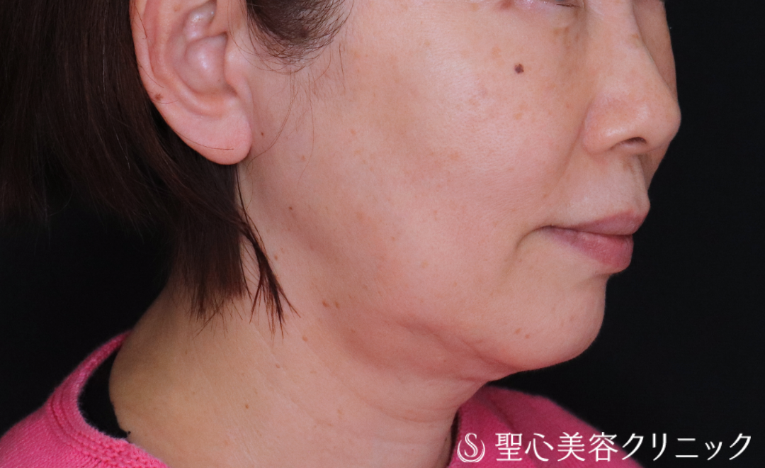【60代女性・輪郭を整えて自然と若々しく】ヒアルロン酸注入（1ヶ月後） Before 