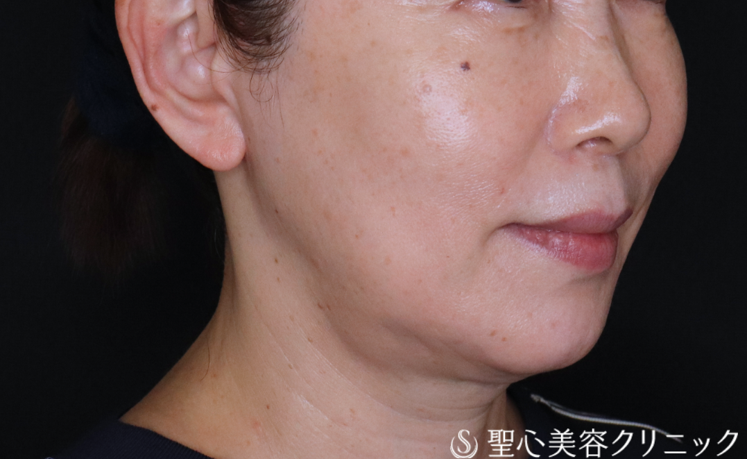 【60代女性・輪郭を整えて自然と若々しく】ヒアルロン酸注入（1ヶ月後） After 