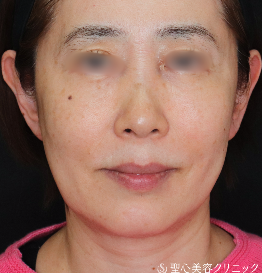 【60代女性・輪郭を整えて自然と若々しく】ヒアルロン酸注入（1ヶ月後） Before 