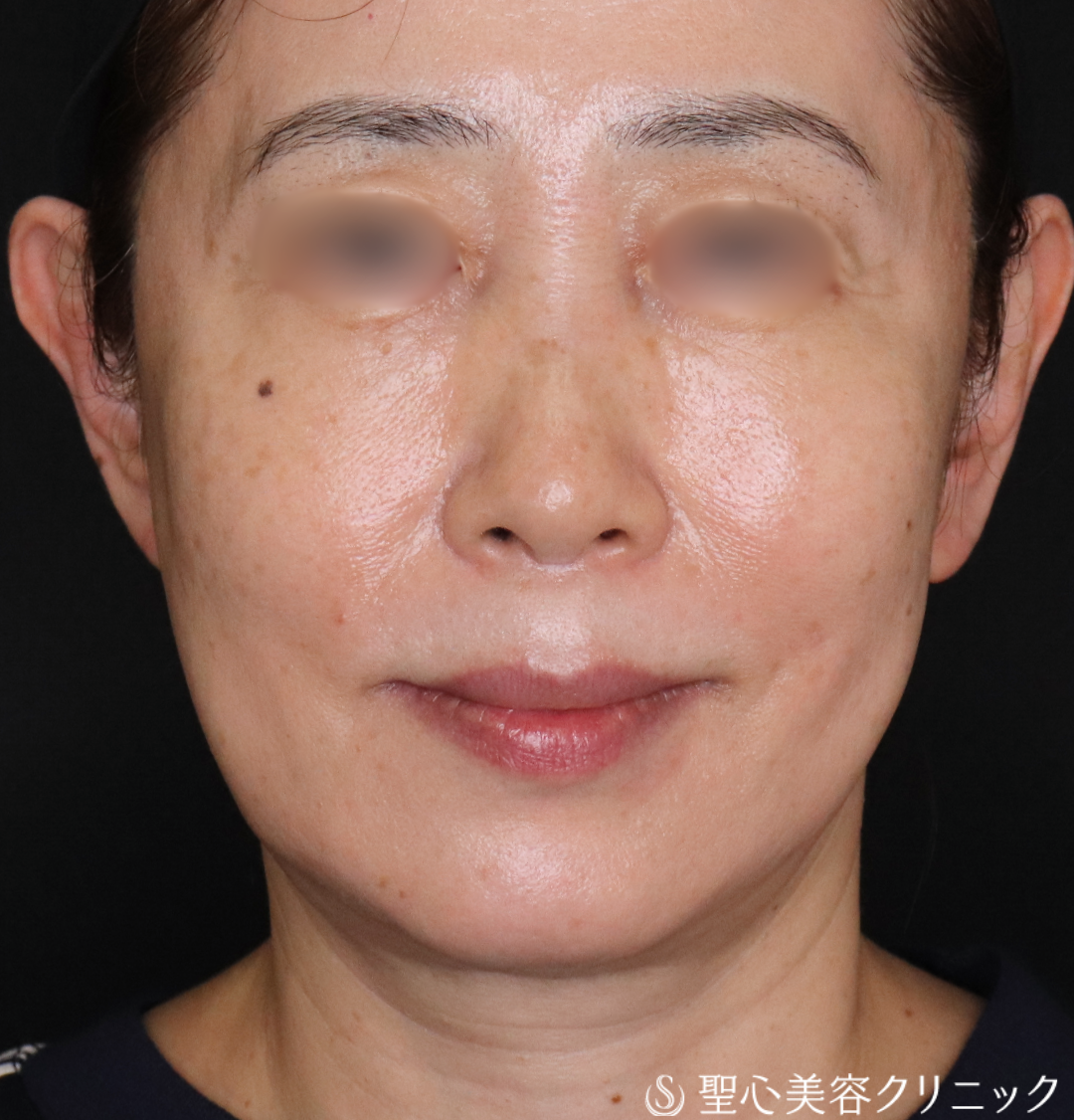 【60代女性・輪郭を整えて自然と若々しく】ヒアルロン酸注入（1ヶ月後） After 