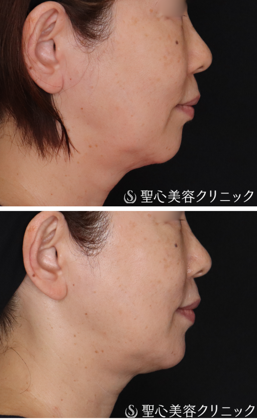【60代女性・輪郭を整えて自然と若々しく】ヒアルロン酸注入（1ヶ月後） After 