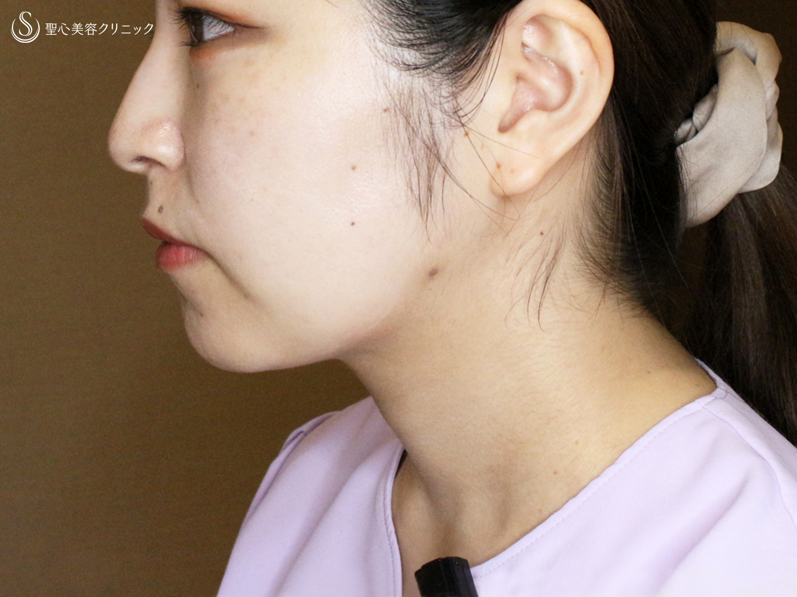 【20代女性・札幌院スタッフ②】あご下の脂肪吸引注射（術直後〜1ヶ月後） After 