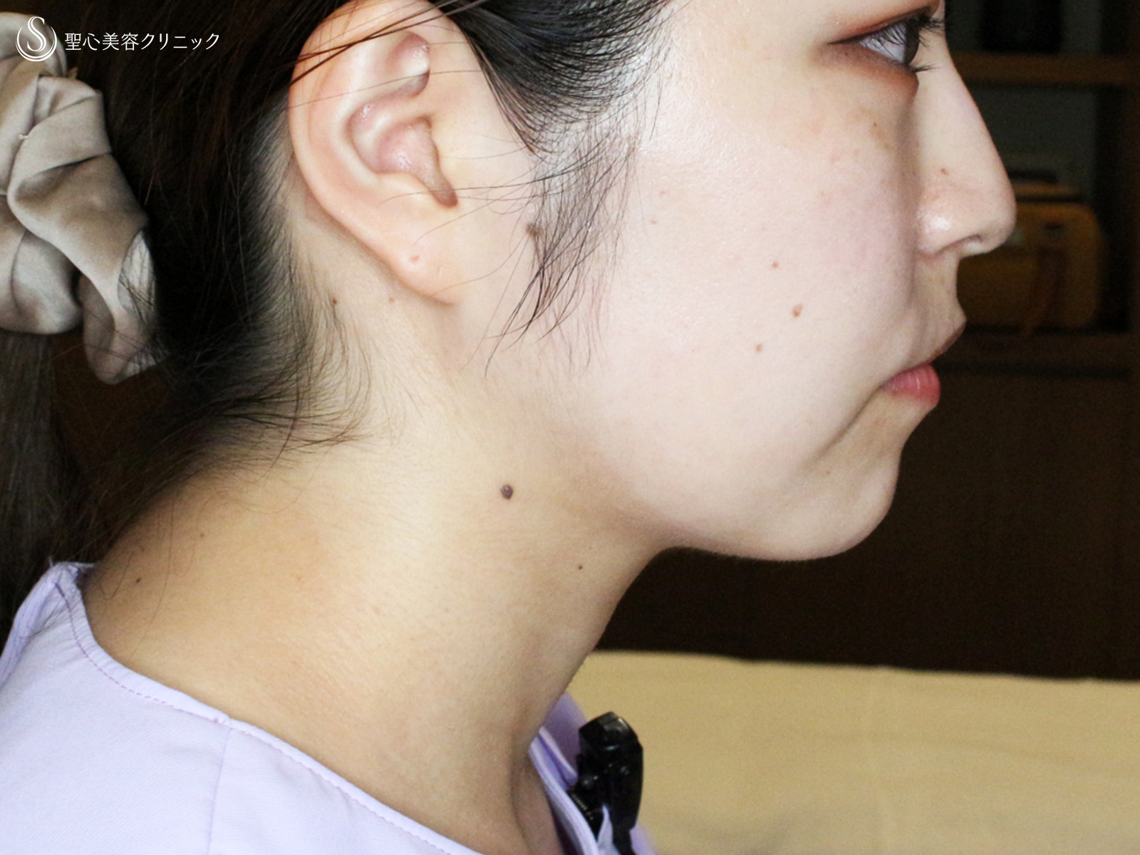【20代女性・札幌院スタッフ②】あご下の脂肪吸引注射（術直後〜1ヶ月後） After 