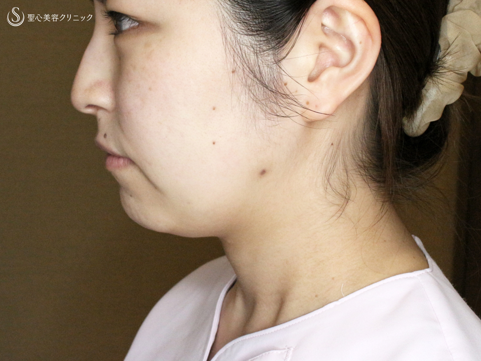【20代女性・札幌院ナース】脂肪吸引注射「あご下」（直後〜8日目） Before 