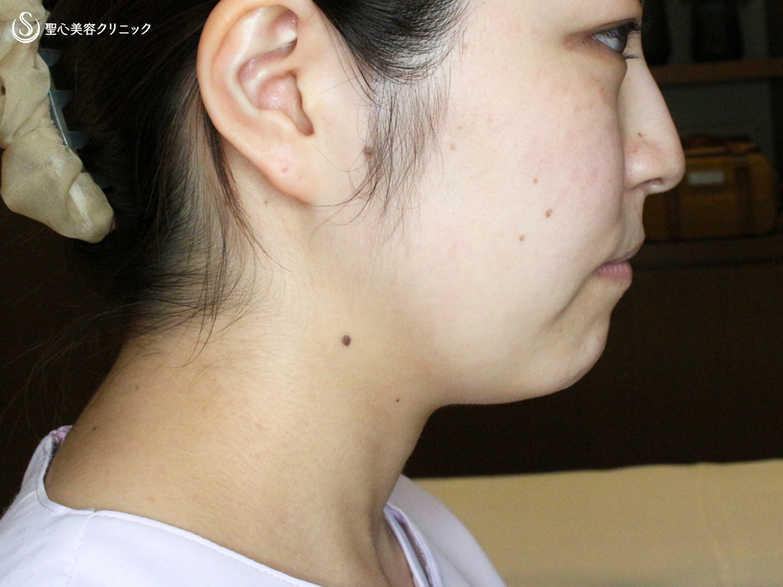【20代女性・札幌院ナース】脂肪吸引注射「あご下」（直後〜8日目） Before 