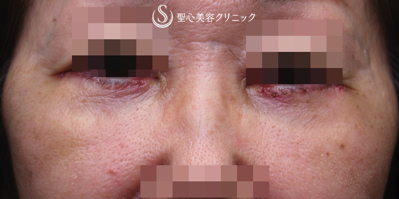 【60代女性・目元の若返り】ハムラ法（1週間後） After 