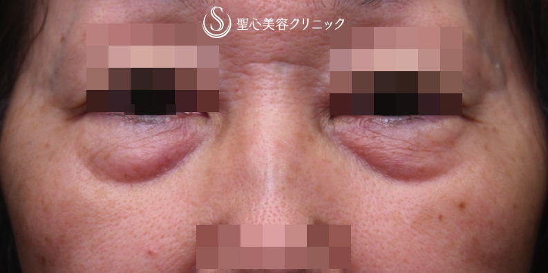 【60代女性・目元の若返り】ハムラ法（1週間後） Before 