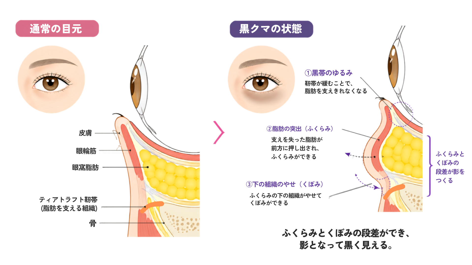 黒クマ（影クマ）の特徴