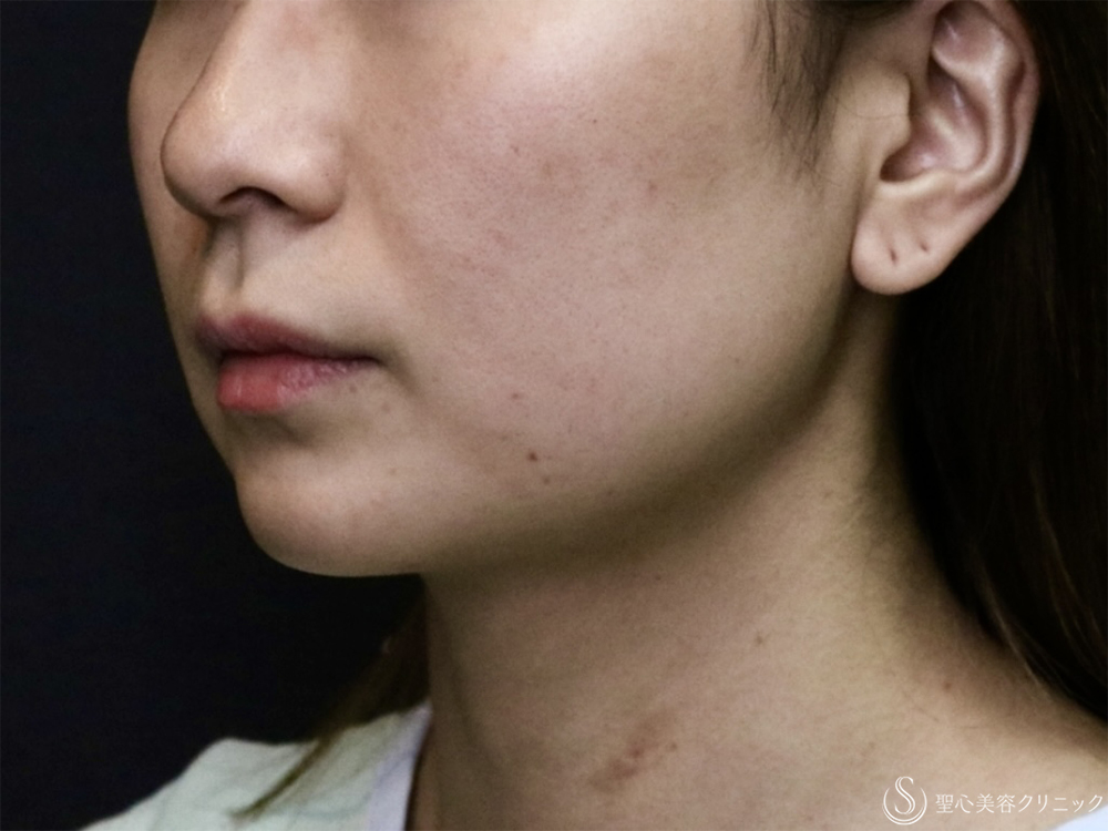 【30代女性・フェイスラインのもたつき】脂肪吸引注射（頬＋あご下）＋アンカーマックス（糸リフト）（3ヶ月後） Before 