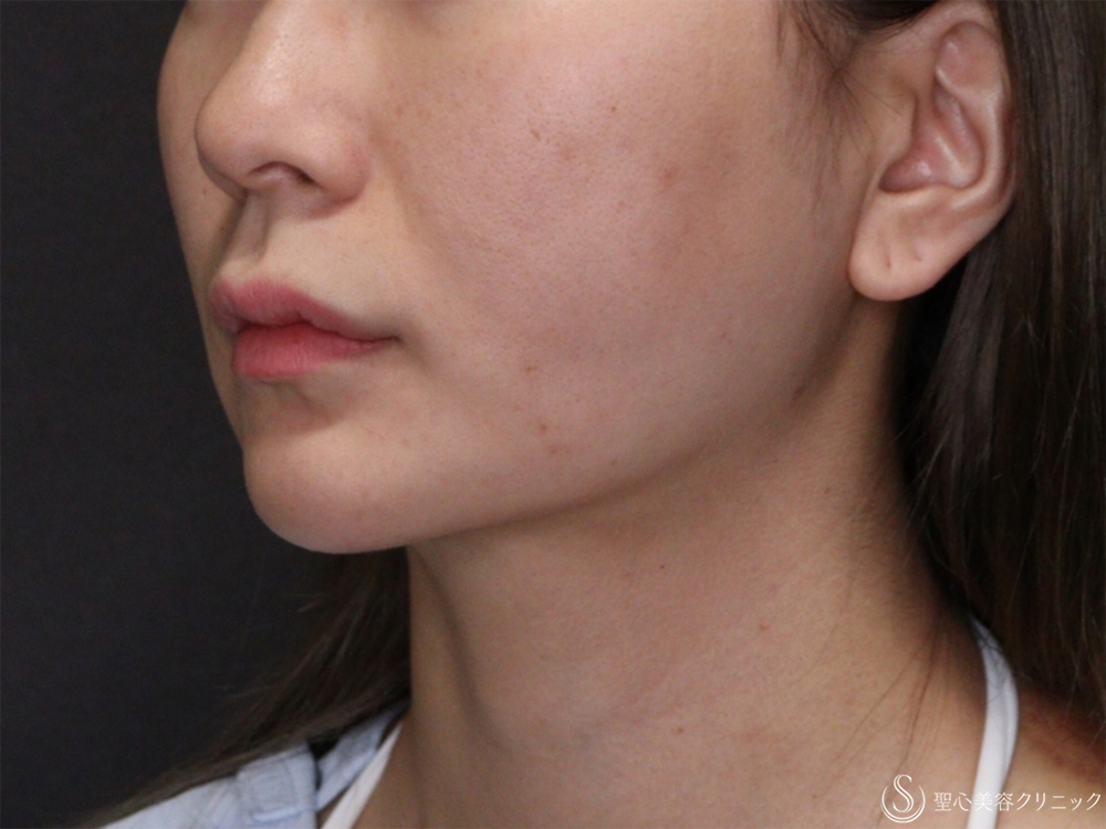 【30代女性・フェイスラインのもたつき】脂肪吸引注射（頬＋あご下）＋アンカーマックス（糸リフト）（3ヶ月後） After 