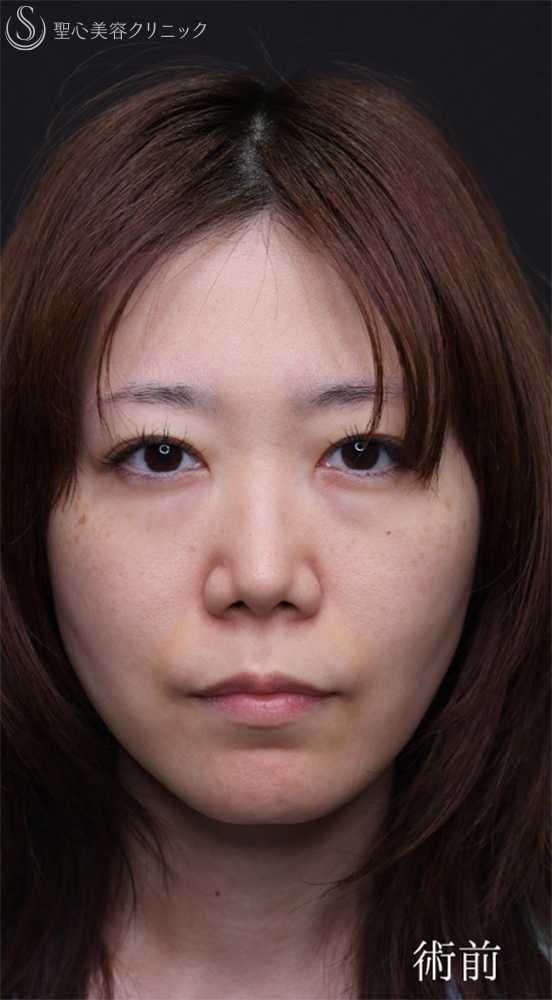 【30代女性・涙袋を強調させる】裏ハムラ法（1ヶ月後） Before 