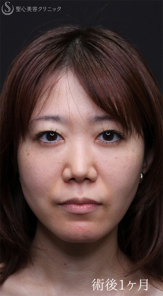 【30代女性・涙袋を強調させる】裏ハムラ法（1ヶ月後） After 