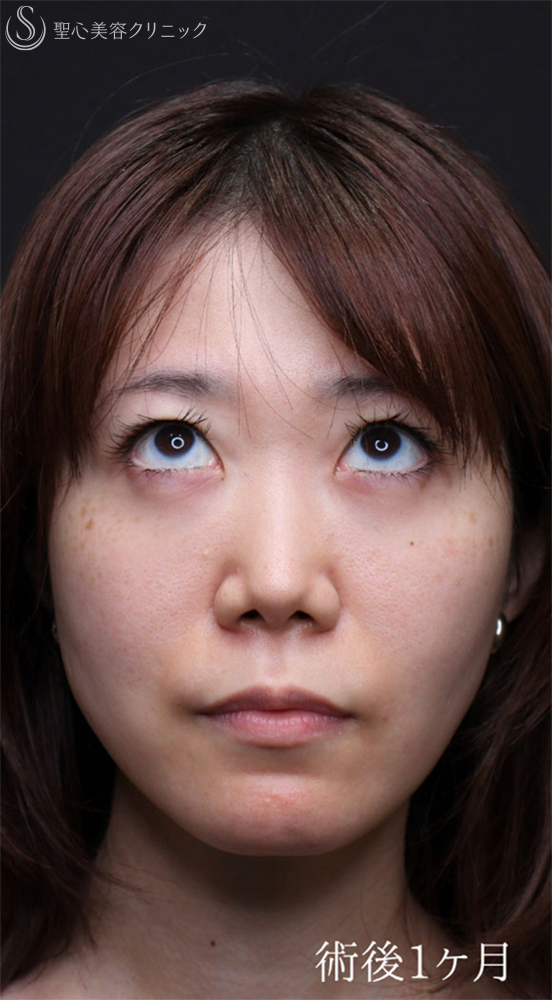 【30代女性・涙袋を強調させる】裏ハムラ法（1ヶ月後） After 