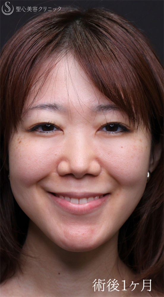 【30代女性・涙袋を強調させる】裏ハムラ法（1ヶ月後） After 