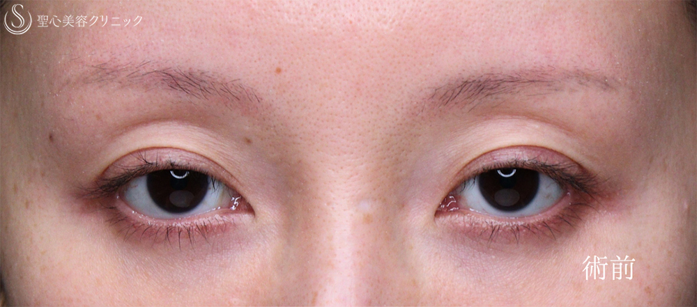 【40代女性・目の開きを改善】眼瞼下垂（埋没法）（8日後） Before 