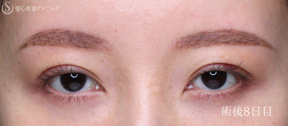 【40代女性・目の開きを改善】眼瞼下垂（埋没法）（8日後） After 