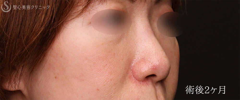 【40代女性・鼻の左右差を改善し、小鼻をスッキリ】小鼻縮小＋鼻孔縁下降術（2ヶ月後） After 
