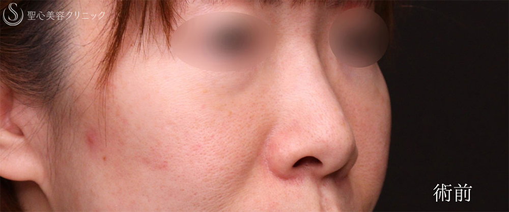 【40代女性・鼻の左右差を改善し、小鼻をスッキリ】小鼻縮小＋鼻孔縁下降術（2ヶ月後） Before 