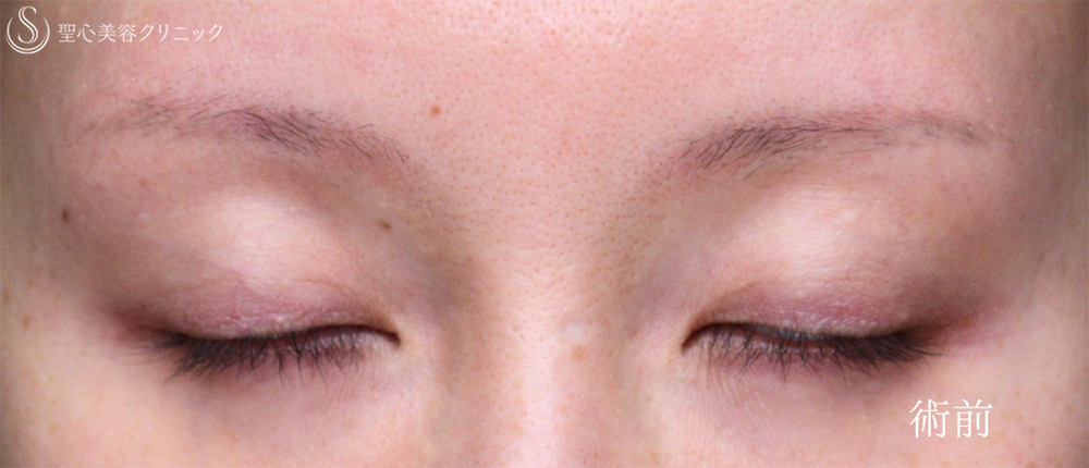 【40代女性・目の開きを改善】眼瞼下垂（埋没法）（8日後） Before 