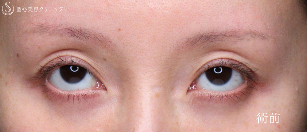 【40代女性・目の開きを改善】眼瞼下垂（埋没法）（8日後） Before 