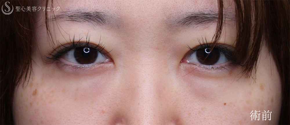 【30代女性・涙袋を強調させる】裏ハムラ法（1ヶ月後） Before 