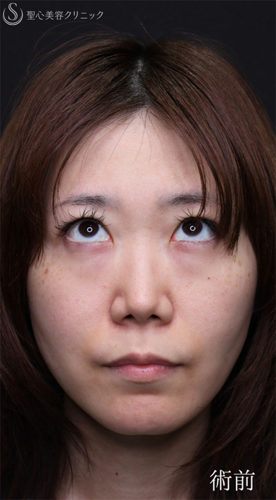 【30代女性・涙袋を強調させる】裏ハムラ法（1ヶ月後） Before 