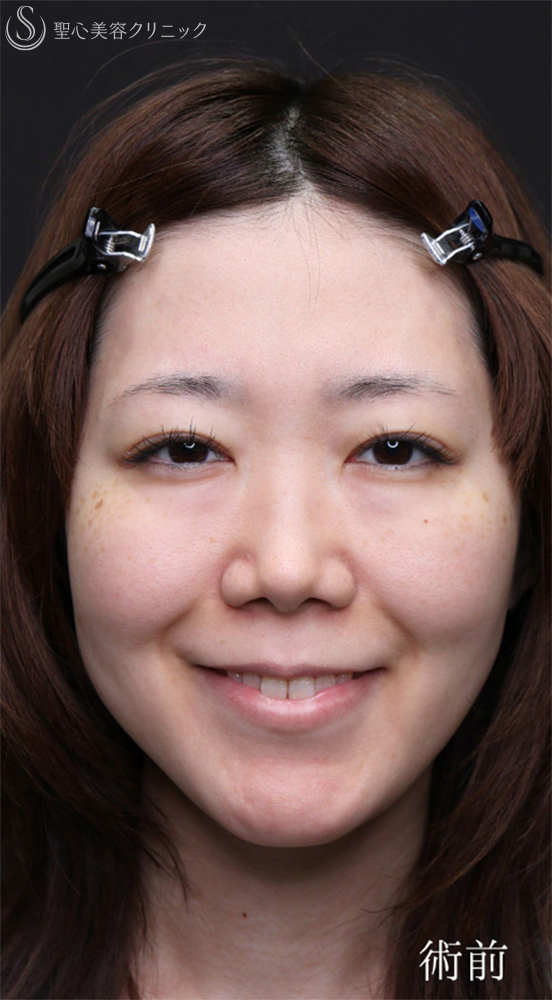 【30代女性・涙袋を強調させる】裏ハムラ法（1ヶ月後） Before 