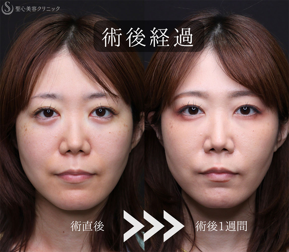 【30代女性・涙袋を強調させる】裏ハムラ法（1ヶ月後） After 