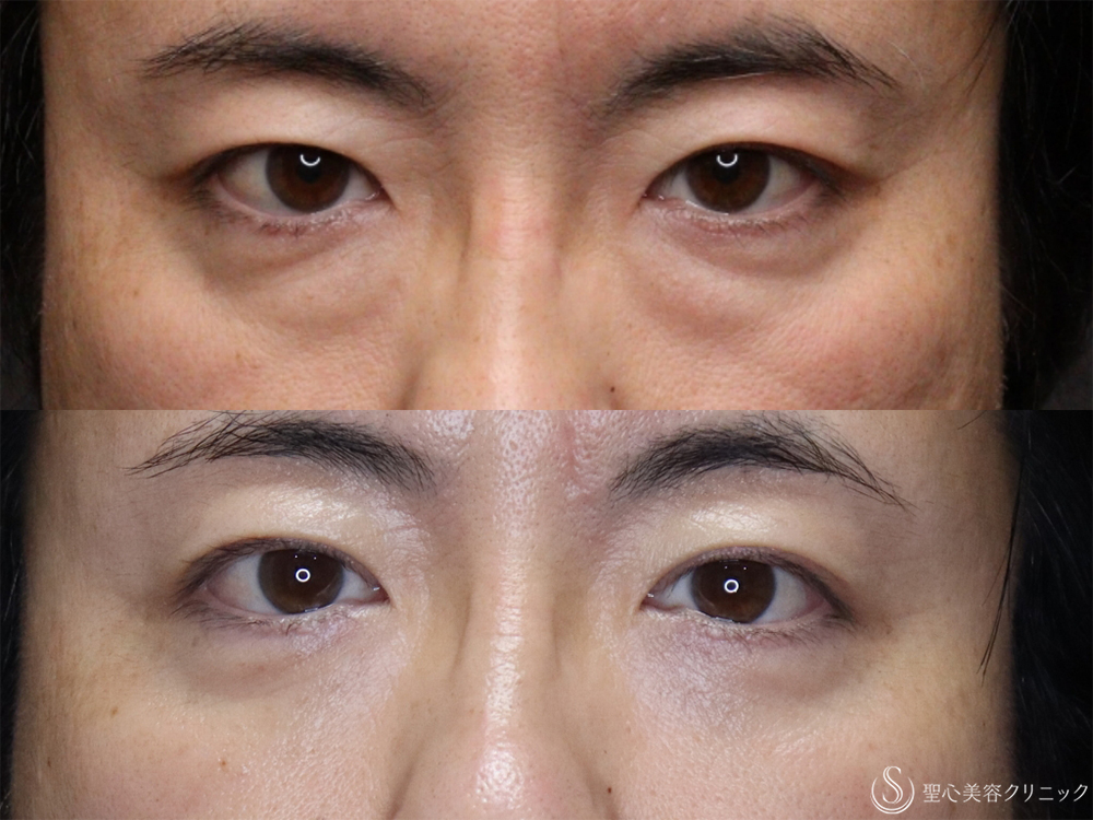 【40代男性・目の下のふくらみ治療】経結膜側脱脂（3ヶ月後） After 
