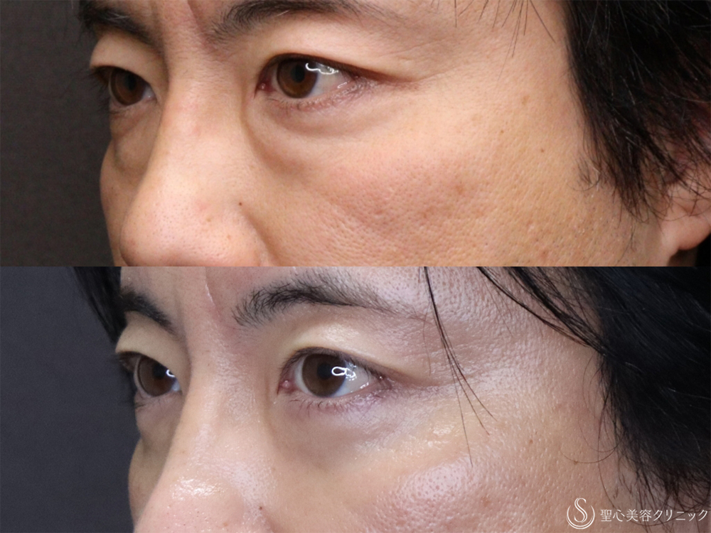 【40代男性・目の下のふくらみ治療】経結膜側脱脂（3ヶ月後） After 