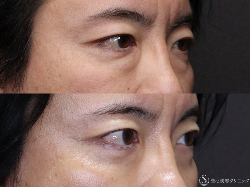 【40代男性・目の下のふくらみ治療】経結膜側脱脂（3ヶ月後） After 