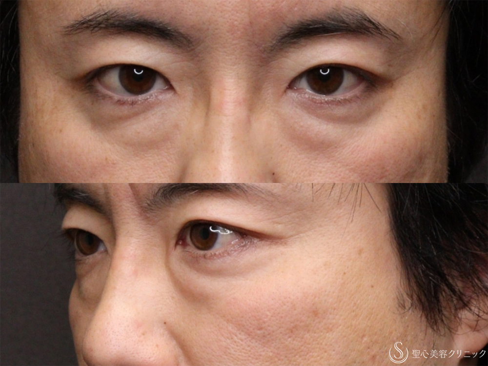 【40代男性・目の下のふくらみ治療】経結膜側脱脂（3ヶ月後） Before 