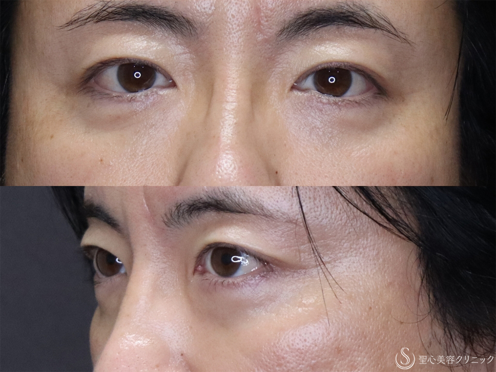 【40代男性・目の下のふくらみ治療】経結膜側脱脂（3ヶ月後） After 