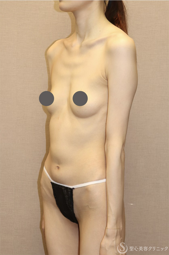 【30代女性・華奢なデコルテも、ボリュームも妥協しない豊胸】ハイブリッド豊胸術（コンポジット豊胸）（3ヶ月後） Before 