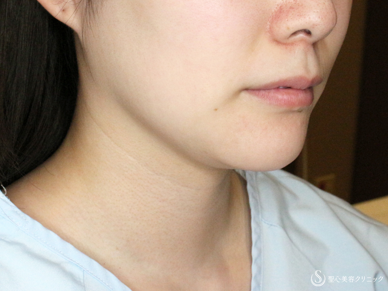 【30代女性・美しさに磨きをかける】脂肪吸引注射 あご下（術直後〜4ヶ月後） Before 