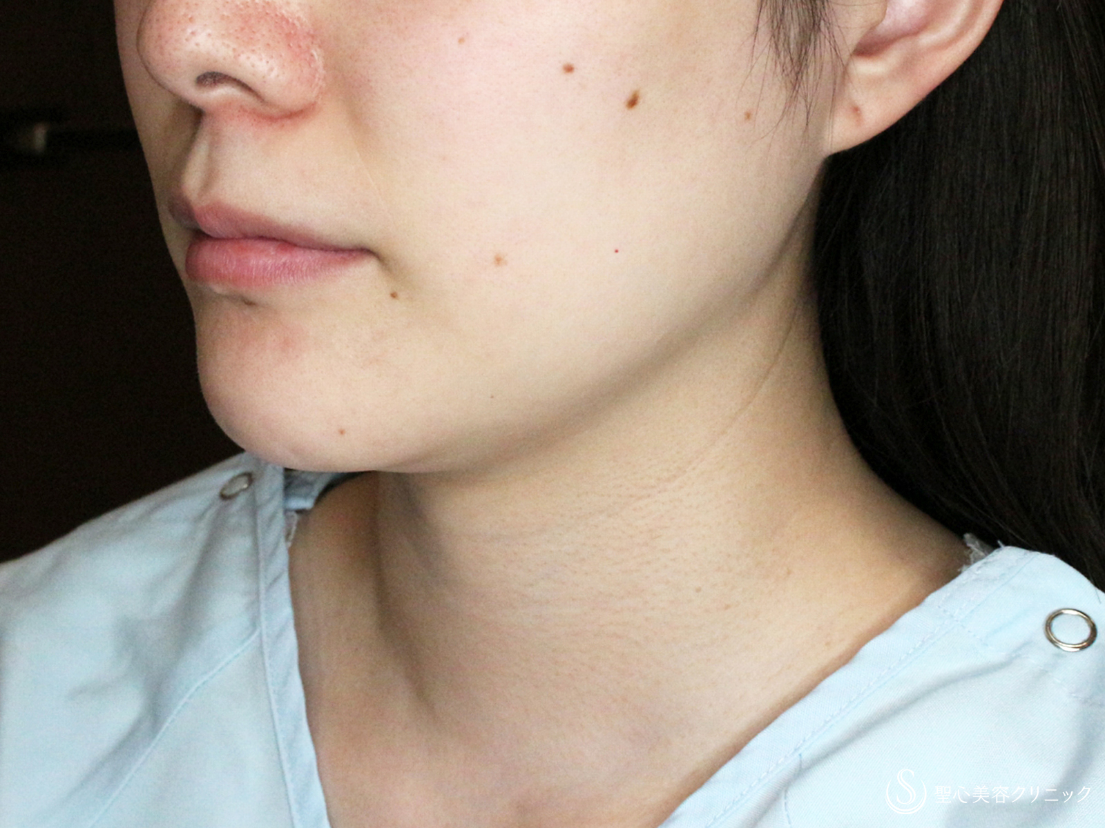 【30代女性・美しさに磨きをかける】脂肪吸引注射 あご下（術直後〜4ヶ月後） Before 