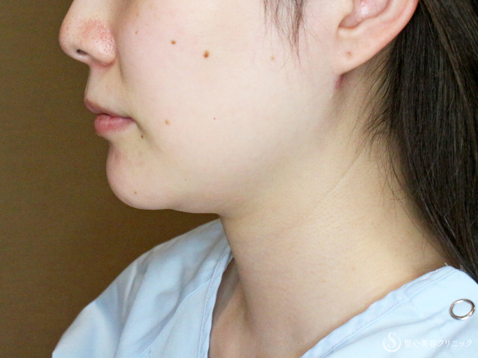 【30代女性・美しさに磨きをかける】脂肪吸引注射 あご下（術直後〜4ヶ月後） Before 