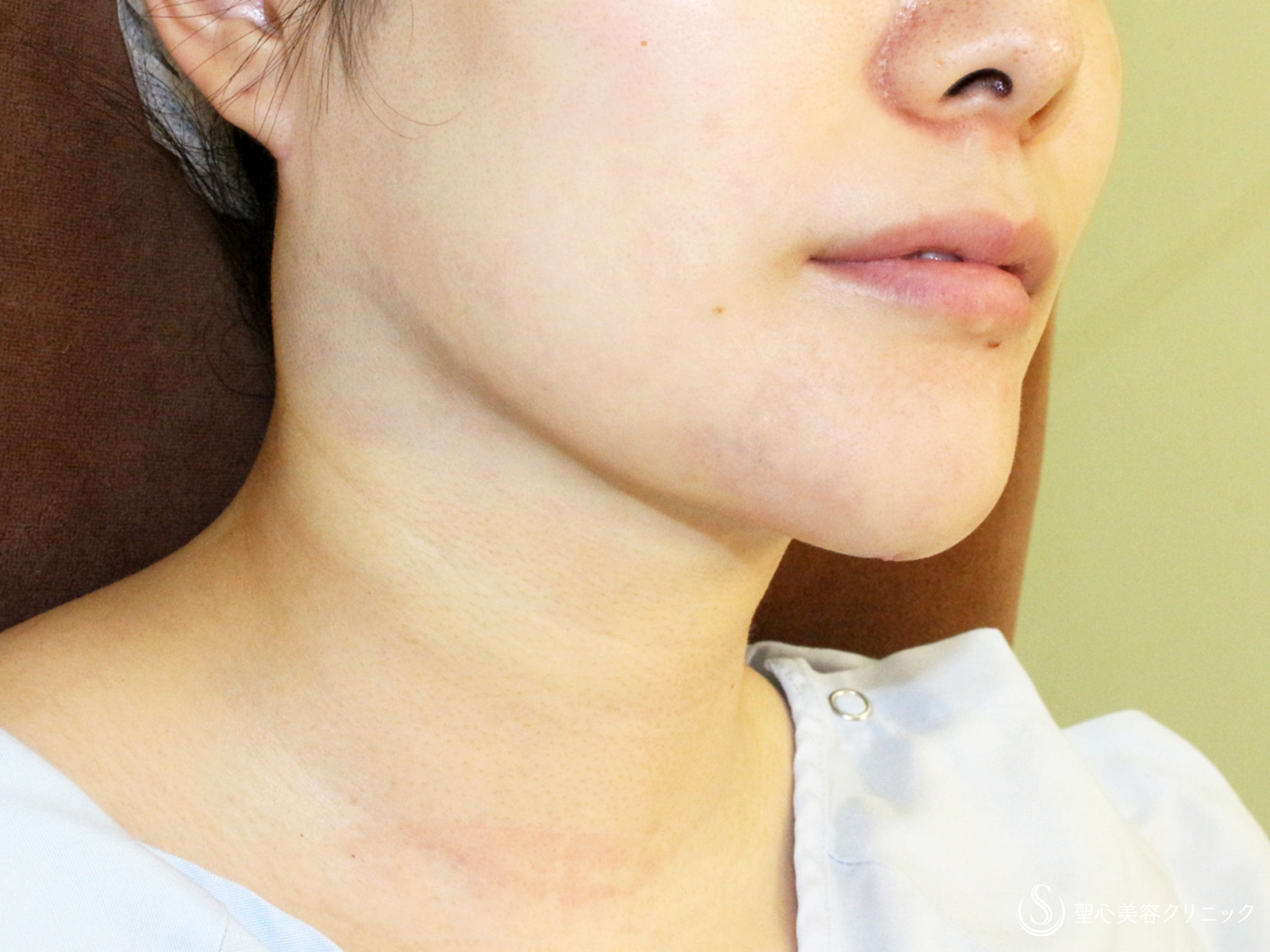 【30代女性・美しさに磨きをかける】脂肪吸引注射 あご下（術直後〜4ヶ月後） Before 