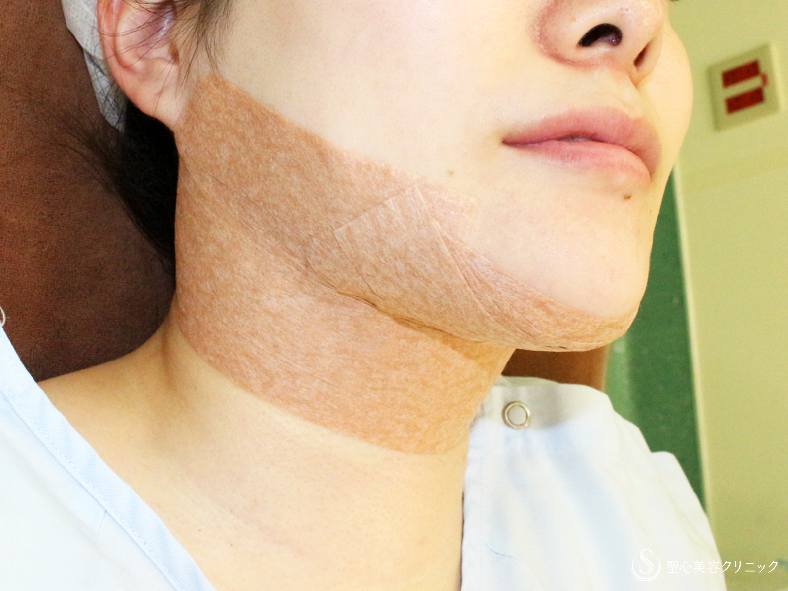 【30代女性・美しさに磨きをかける】脂肪吸引注射 あご下（術直後〜4ヶ月後） Before 