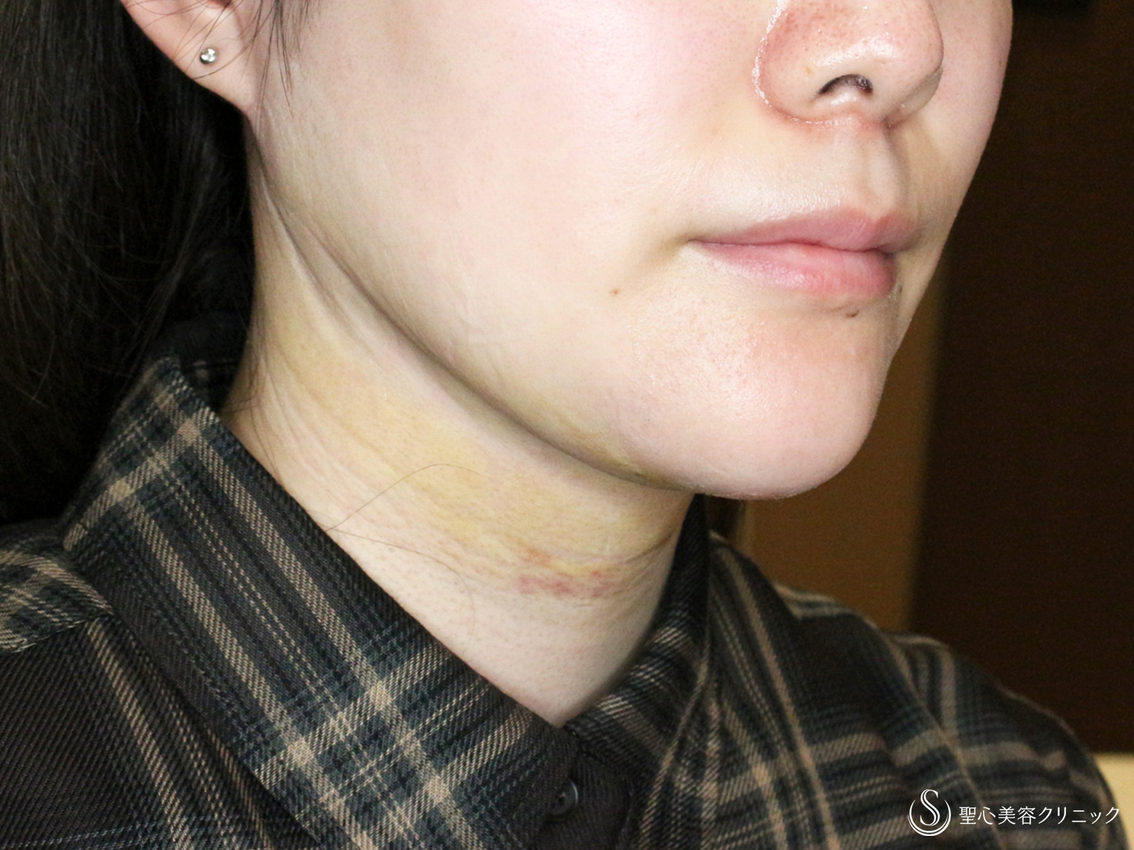 【30代女性・美しさに磨きをかける】脂肪吸引注射 あご下（術直後〜4ヶ月後） After 