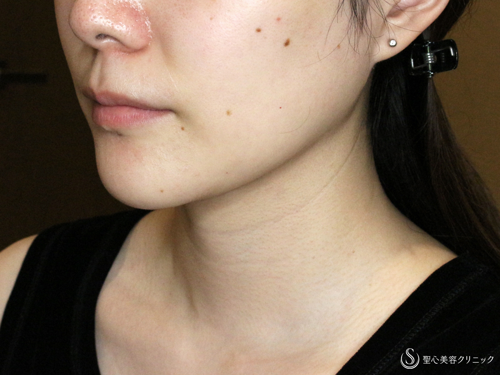 【30代女性・美しさに磨きをかける】脂肪吸引注射 あご下（術直後〜4ヶ月後） After 