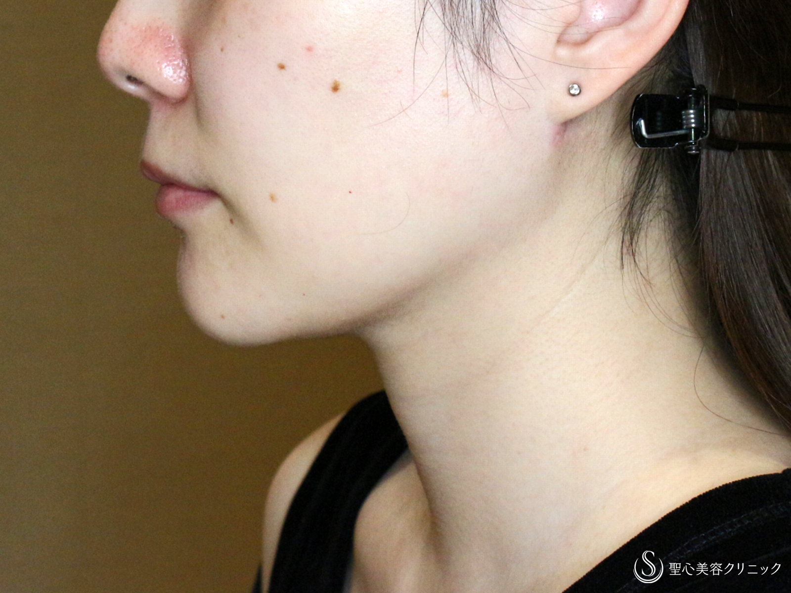 【30代女性・美しさに磨きをかける】脂肪吸引注射 あご下（術直後〜4ヶ月後） After 