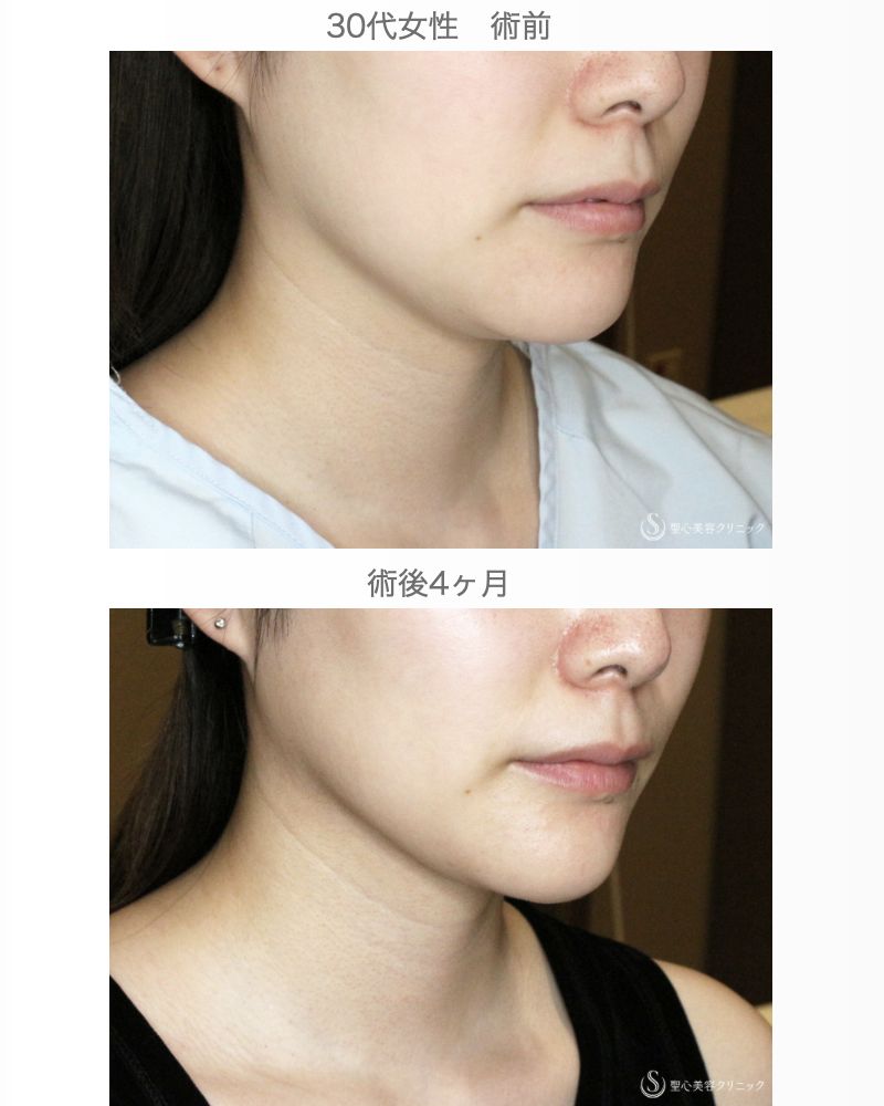 【30代女性・美しさに磨きをかける】脂肪吸引注射 あご下（術直後〜4ヶ月後） After 