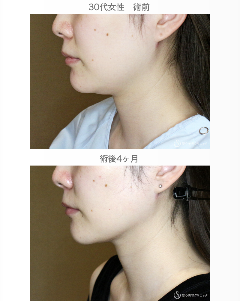 【30代女性・美しさに磨きをかける】脂肪吸引注射 あご下（術直後〜4ヶ月後） After 