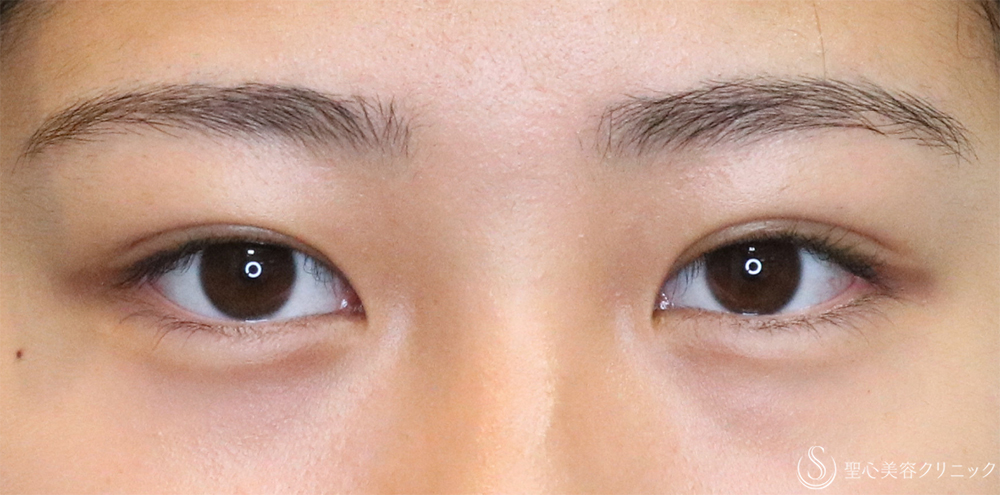 【10代女性・自然な二重に】二重埋没法（ダブルノット法）（1ヶ月後） After 名古屋・二重・埋没法
