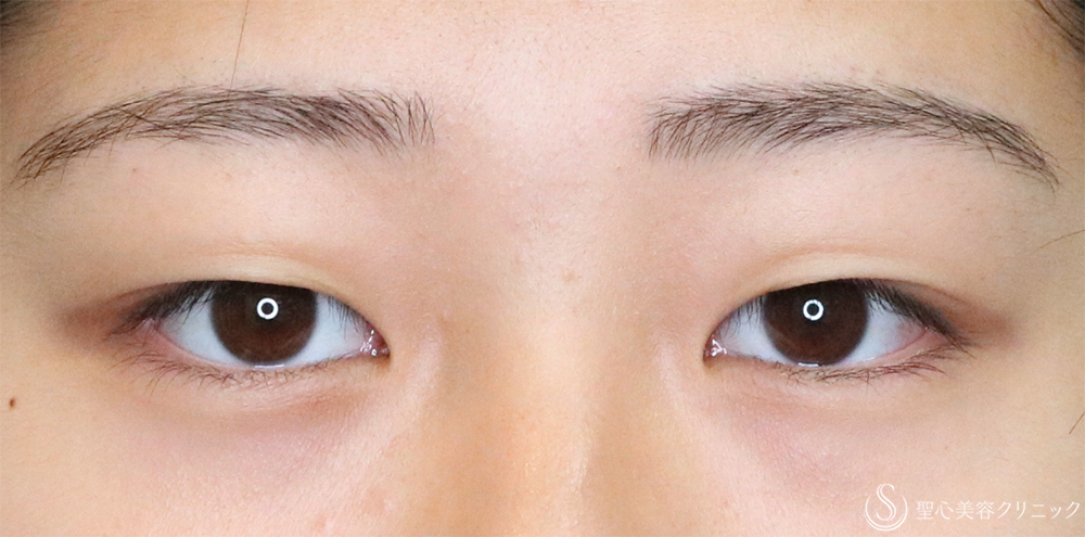 【10代女性・自然な二重に】二重埋没法（ダブルノット法）（1ヶ月後） Before 名古屋・二重・埋没法